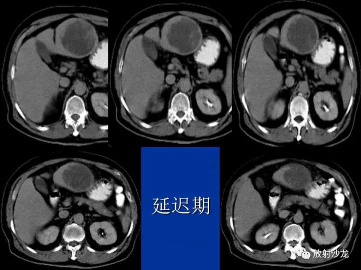 【病例】肝囊肿伴液化坏死部分出血1例MR