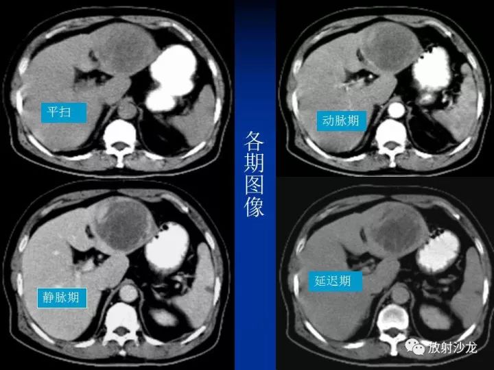 【病例】肝囊肿伴液化坏死部分出血1例MR