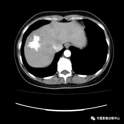 【病例】中心向边缘强化的血管瘤1例CT影像表现 【病例】中心向边缘强化的血管瘤1例CT影像表现