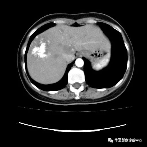 【病例】中心向边缘强化的血管瘤1例CT影像表现 【病例】中心向边缘强化的血管瘤1例CT影像表现