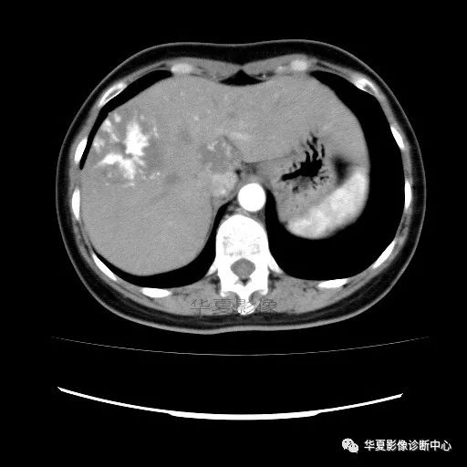【病例】中心向边缘强化的血管瘤1例CT影像表现