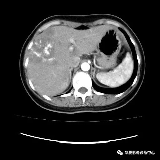 【病例】中心向边缘强化的血管瘤1例CT影像表现 【病例】中心向边缘强化的血管瘤1例CT影像表现