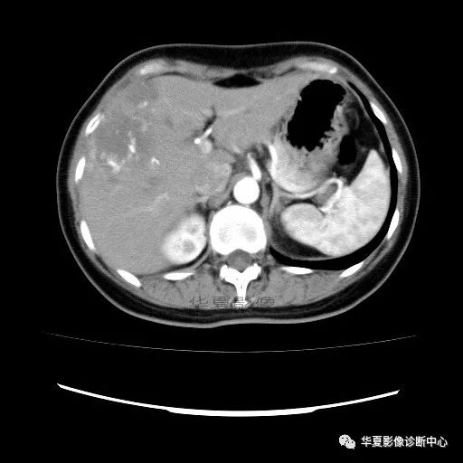 【病例】中心向边缘强化的血管瘤1例CT影像表现 【病例】中心向边缘强化的血管瘤1例CT影像表现