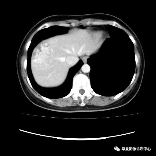 【病例】中心向边缘强化的血管瘤1例CT影像表现 【病例】中心向边缘强化的血管瘤1例CT影像表现