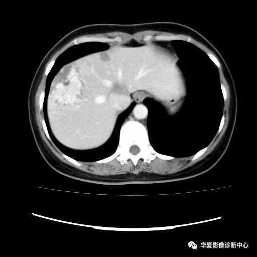 【病例】中心向边缘强化的血管瘤1例CT影像表现 【病例】中心向边缘强化的血管瘤1例CT影像表现