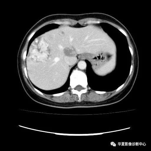 【病例】中心向边缘强化的血管瘤1例CT影像表现 【病例】中心向边缘强化的血管瘤1例CT影像表现