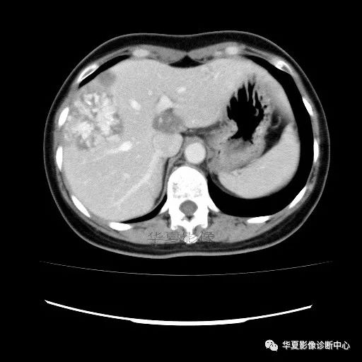 【病例】中心向边缘强化的血管瘤1例CT影像表现 【病例】中心向边缘强化的血管瘤1例CT影像表现