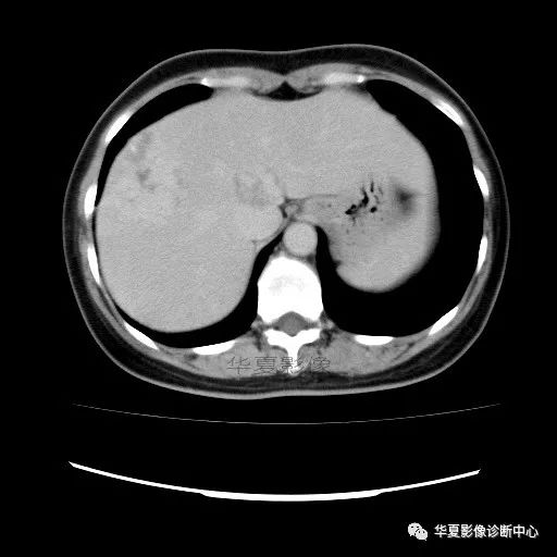 【病例】中心向边缘强化的血管瘤1例CT影像表现 【病例】中心向边缘强化的血管瘤1例CT影像表现