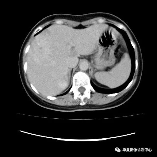 【病例】中心向边缘强化的血管瘤1例CT影像表现 【病例】中心向边缘强化的血管瘤1例CT影像表现