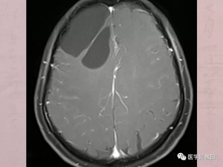 【病例】蛛网膜囊肿1例MR影像表现 【病例】蛛网膜囊肿1例MR影像表现