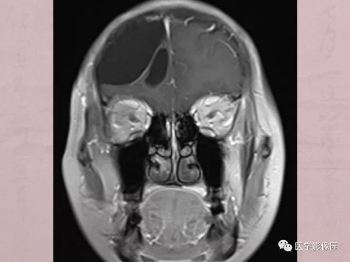 【病例】蛛网膜囊肿1例MR影像表现 【病例】蛛网膜囊肿1例MR影像表现