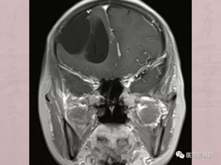 【病例】蛛网膜囊肿1例MR影像表现 【病例】蛛网膜囊肿1例MR影像表现