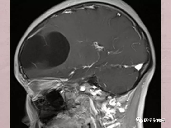 【病例】蛛网膜囊肿1例MR影像表现 【病例】蛛网膜囊肿1例MR影像表现