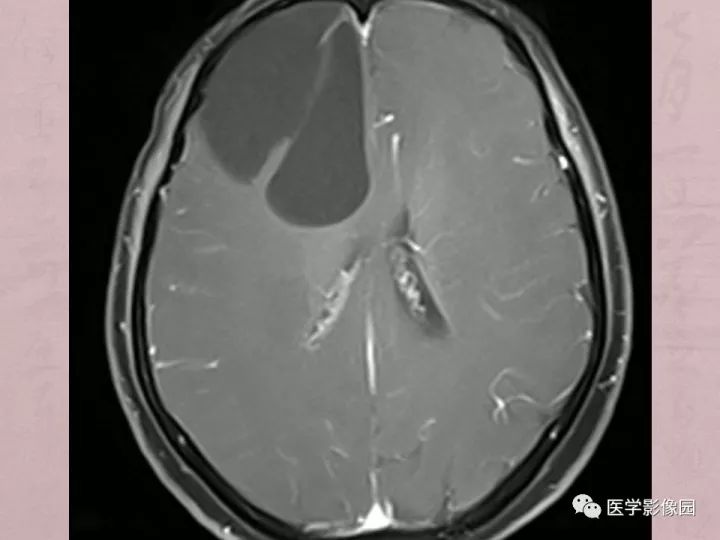 【病例】蛛网膜囊肿1例MR影像表现 【病例】蛛网膜囊肿1例MR影像表现
