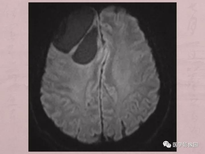 【病例】蛛网膜囊肿1例MR影像表现 【病例】蛛网膜囊肿1例MR影像表现