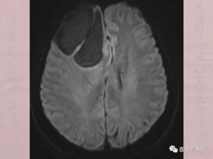 【病例】蛛网膜囊肿1例MR影像表现 【病例】蛛网膜囊肿1例MR影像表现