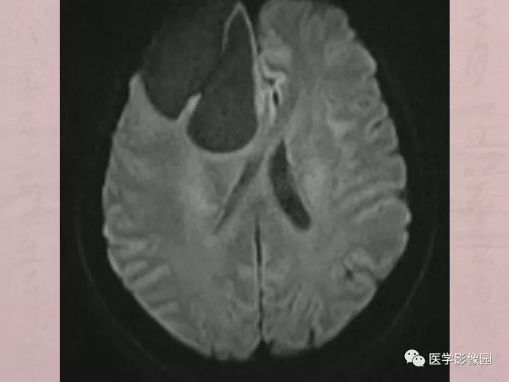 【病例】蛛网膜囊肿1例MR影像表现 【病例】蛛网膜囊肿1例MR影像表现