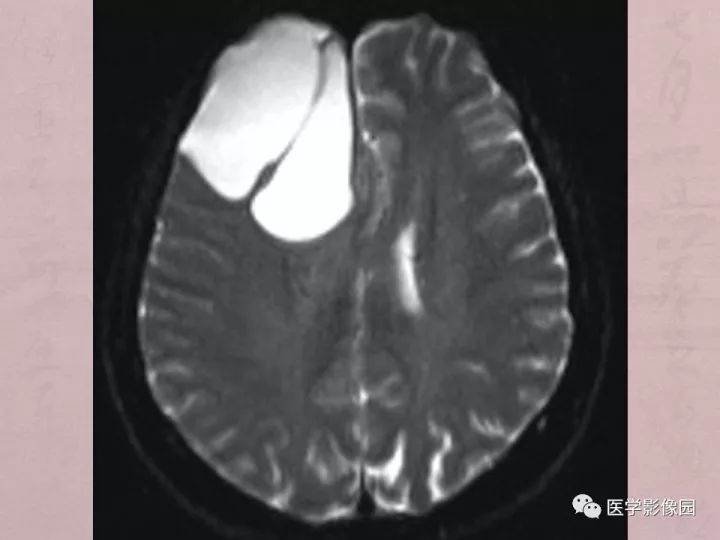 【病例】蛛网膜囊肿1例MR影像表现 【病例】蛛网膜囊肿1例MR影像表现