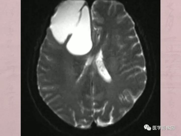 【病例】蛛网膜囊肿1例MR影像表现 【病例】蛛网膜囊肿1例MR影像表现