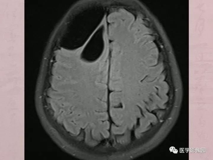 【病例】蛛网膜囊肿1例MR影像表现 【病例】蛛网膜囊肿1例MR影像表现