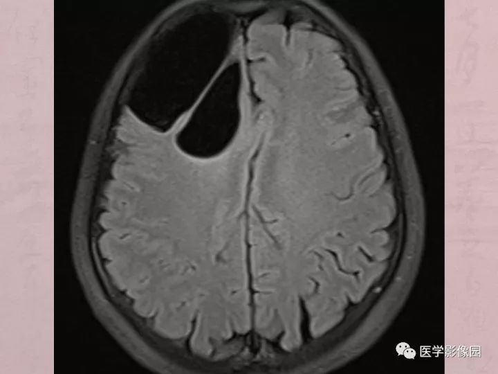 【病例】蛛网膜囊肿1例MR影像表现 【病例】蛛网膜囊肿1例MR影像表现