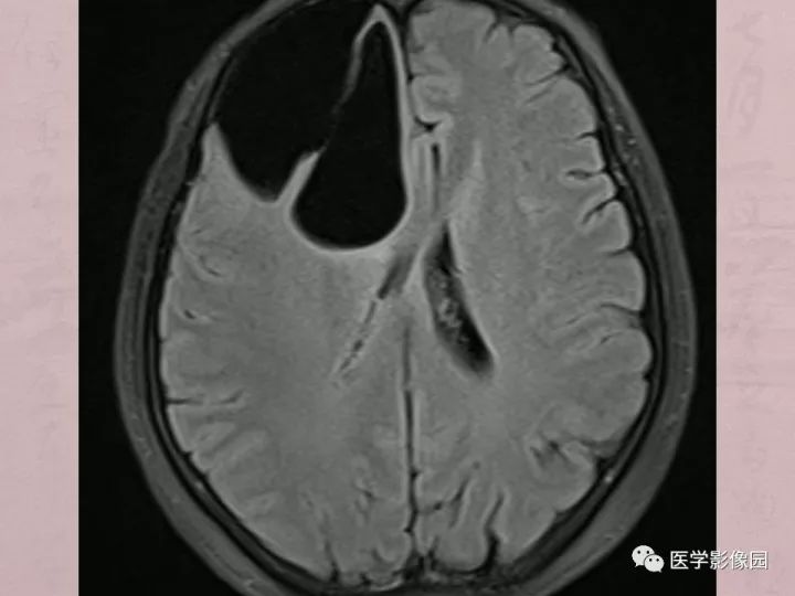 【病例】蛛网膜囊肿1例MR影像表现 【病例】蛛网膜囊肿1例MR影像表现