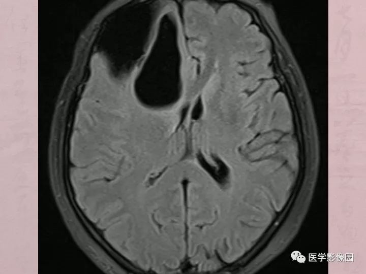 【病例】蛛网膜囊肿1例MR影像表现 【病例】蛛网膜囊肿1例MR影像表现