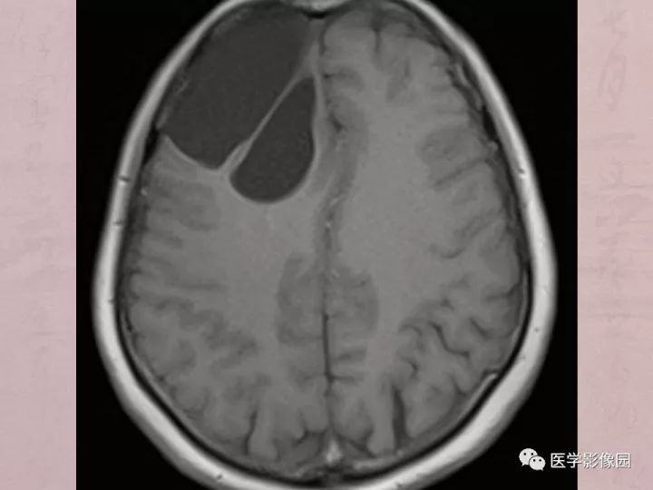 【病例】蛛网膜囊肿1例MR影像表现 【病例】蛛网膜囊肿1例MR影像表现