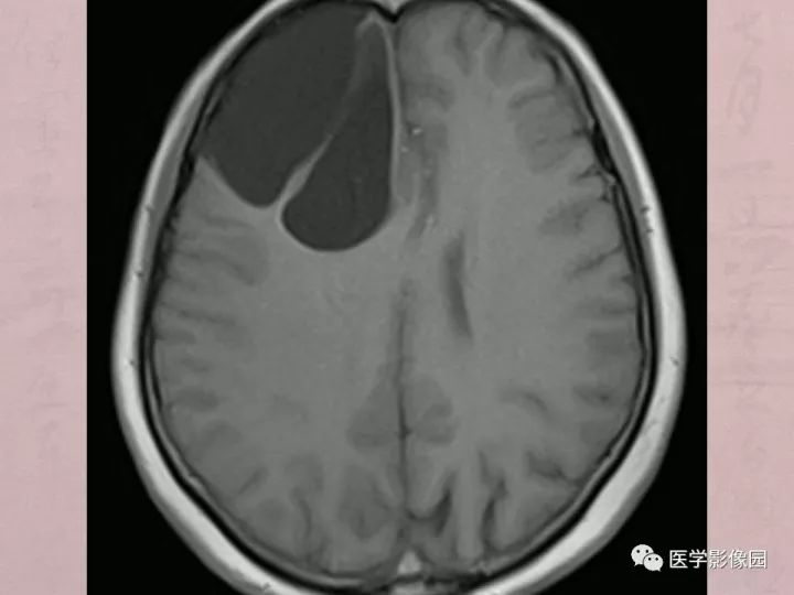【病例】蛛网膜囊肿1例MR影像表现 【病例】蛛网膜囊肿1例MR影像表现