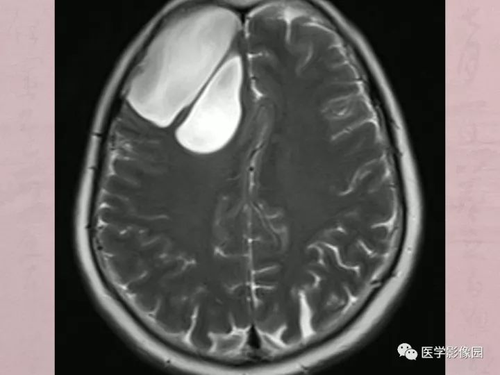 【病例】蛛网膜囊肿1例MR影像表现 【病例】蛛网膜囊肿1例MR影像表现
