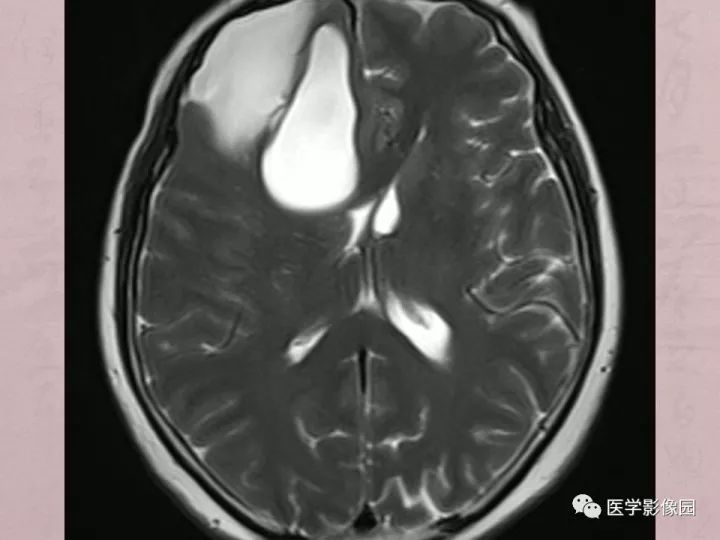 【病例】蛛网膜囊肿1例MR影像表现 【病例】蛛网膜囊肿1例MR影像表现