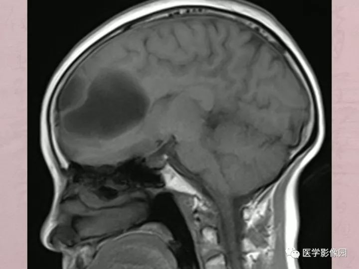 【病例】蛛网膜囊肿1例MR影像表现 【病例】蛛网膜囊肿1例MR影像表现