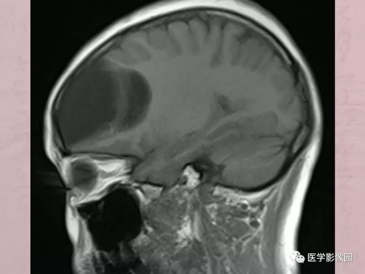 【病例】蛛网膜囊肿1例MR影像表现 【病例】蛛网膜囊肿1例MR影像表现