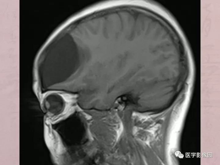 【病例】蛛网膜囊肿1例MR影像表现 【病例】蛛网膜囊肿1例MR影像表现