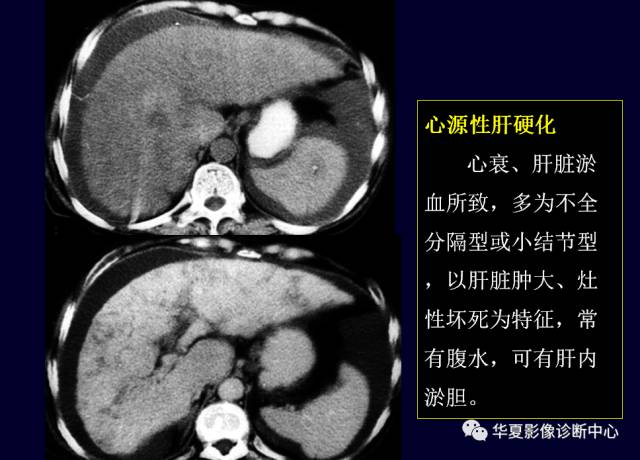 【PPT】非占位性肝病变MRI诊断
