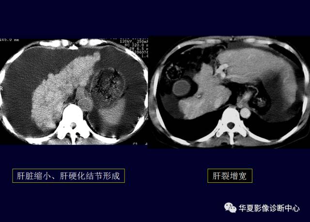 【PPT】非占位性肝病变MRI诊断