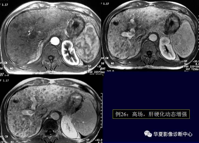 【PPT】非占位性肝病变MRI诊断