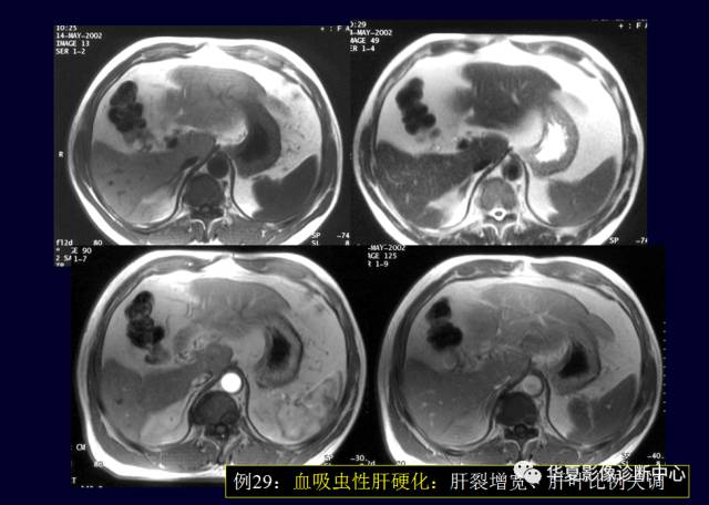 【PPT】非占位性肝病变MRI诊断