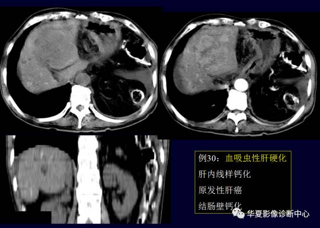 【PPT】非占位性肝病变MRI诊断