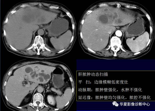 【PPT】非占位性肝病变MRI诊断