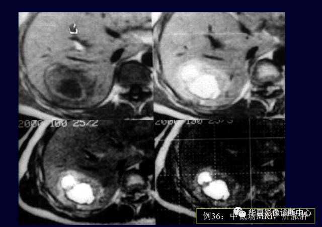 【PPT】非占位性肝病变MRI诊断
