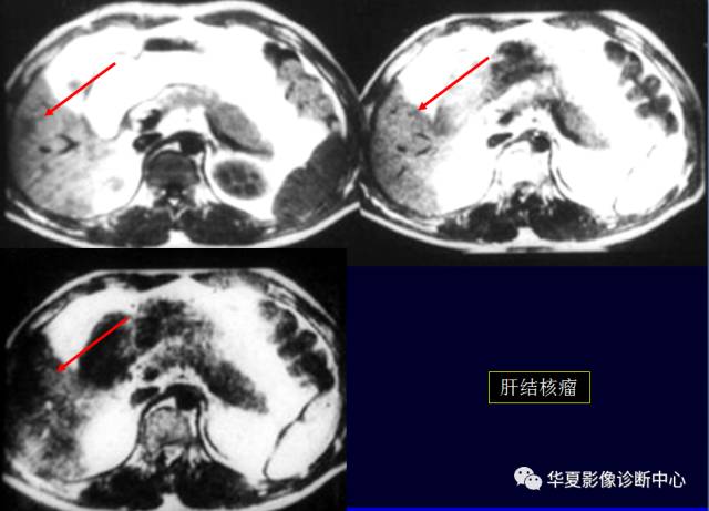 【PPT】非占位性肝病变MRI诊断
