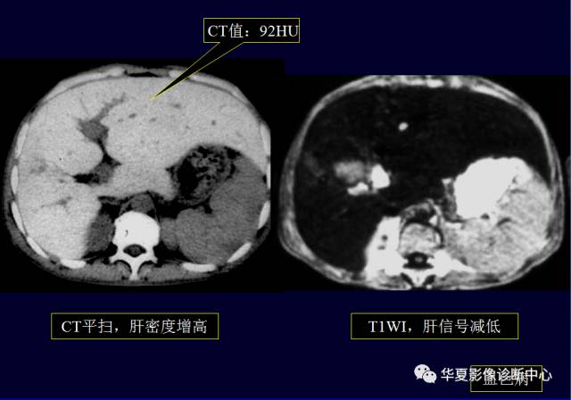 【PPT】非占位性肝病变MRI诊断