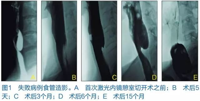 【病例】喉咽部憩室Zenker’s 憩室1例X线造影影像诊断 【病例】喉咽部憩室Zenker’s 憩室1例X线造影影像诊断