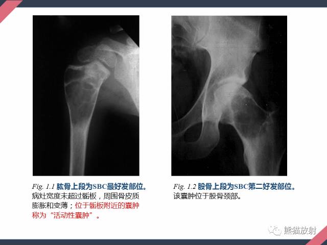 【PPT】骨肿瘤样病变——从病理到影像