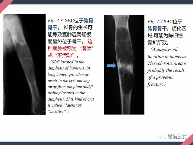 【PPT】骨肿瘤样病变——从病理到影像