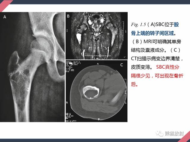 【PPT】骨肿瘤样病变——从病理到影像