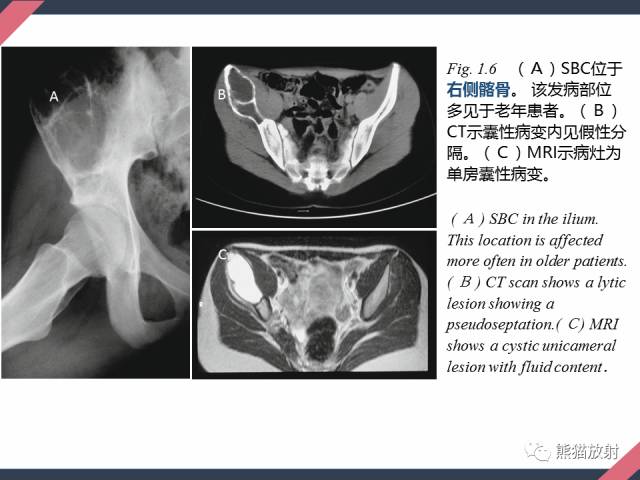 【PPT】骨肿瘤样病变——从病理到影像
