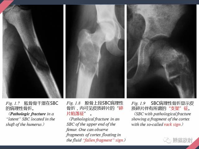 【PPT】骨肿瘤样病变——从病理到影像