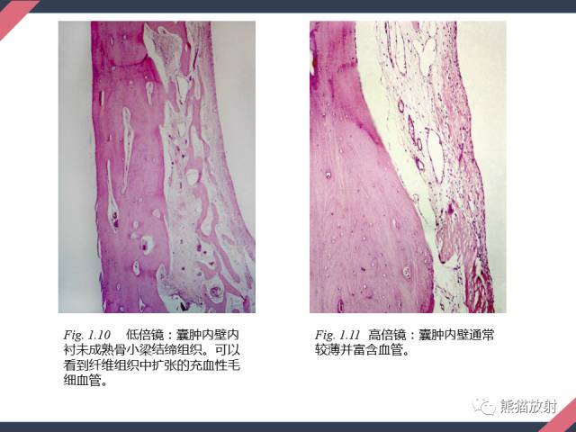 【PPT】骨肿瘤样病变——从病理到影像